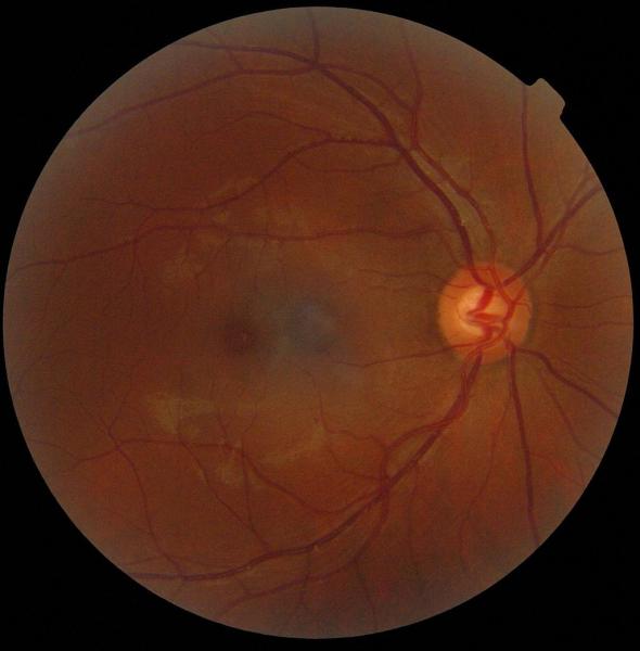 Photo: Optic disc (highlighted) shows area on retina where blood vessels converge, resulting in blind spot. (CC BY-SA 3.0)